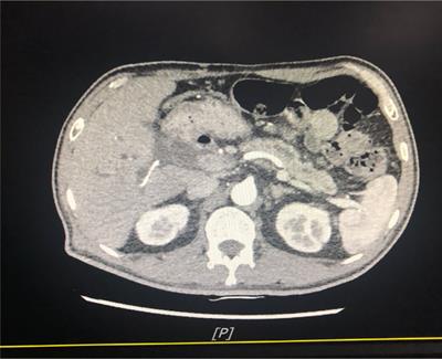 Case Report: A Pancreatic Ductal Adenocarcinoma Patient With Concurrent Targetable Somatic Novel KANK1-ALK, UPP2-NTRK3 Fusion, and Pathogenetic Germline BRCA Mutation